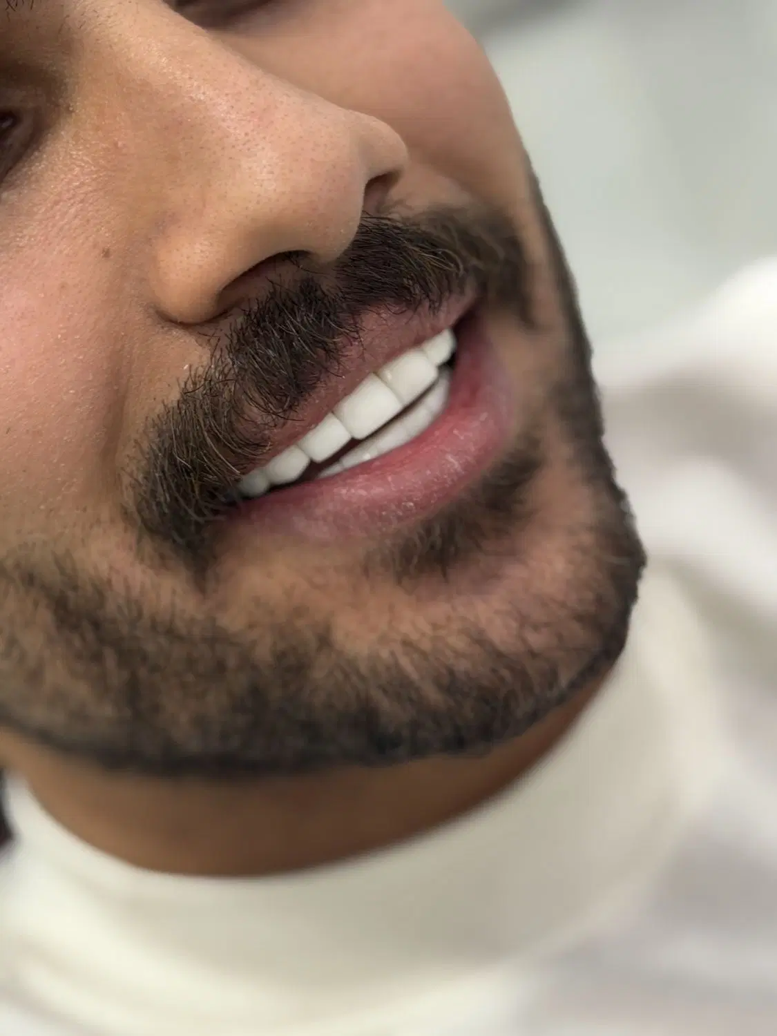 کامپوزیت/روکش/عصبکشی/ایمپلنت/لمینت|خدمات زیبایی و سلامت|تهران, فردوس|دیوار