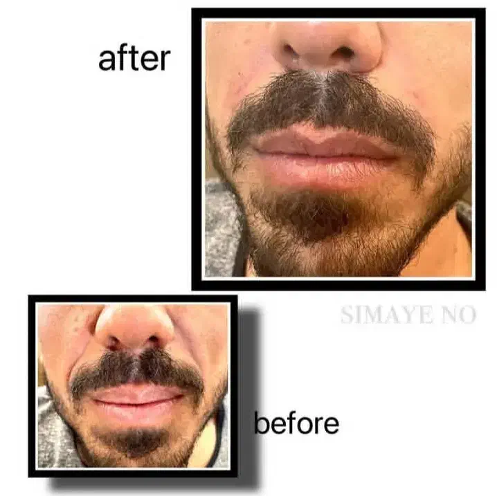 تزریق ژل و بوتاکس، نخ، مزو، فیلربادی|خدمات آرایشگری و زیبایی|ری, اقدسیه|دیوار