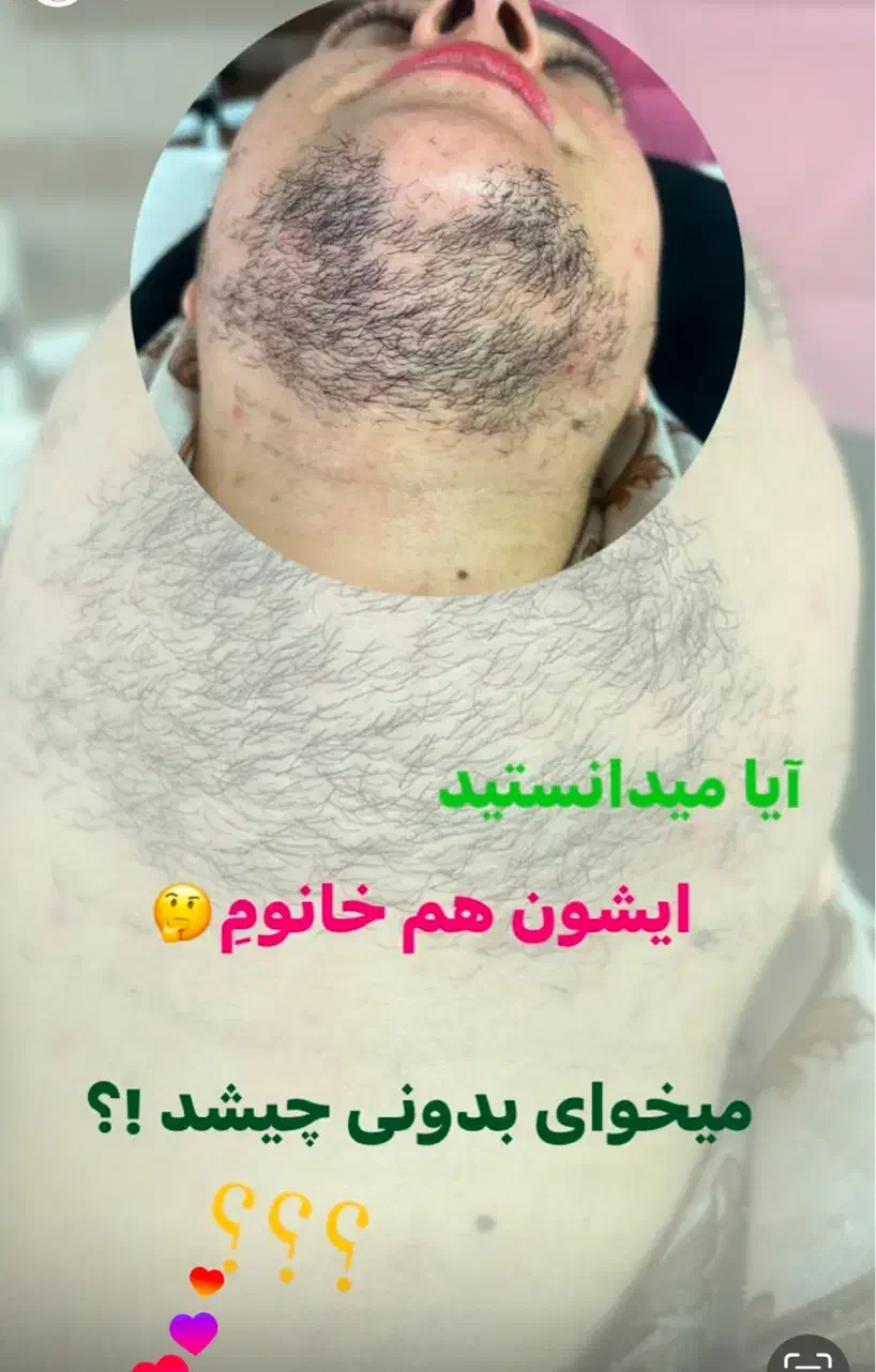 لیزر موهای زائد با برترین دستگاه 2024|خدمات آرایشگری و زیبایی|بم, |دیوار