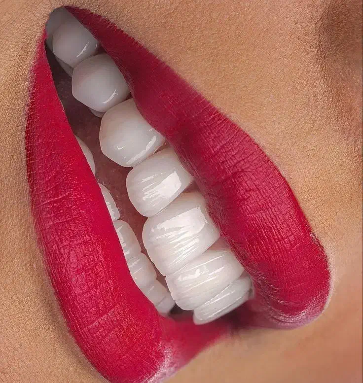 جشنواره کامپوزیت لمینیت روکش عصب ونیر بریدج ترمیم|خدمات آرایشگری و زیبایی|تهران, هفت حوض|دیوار