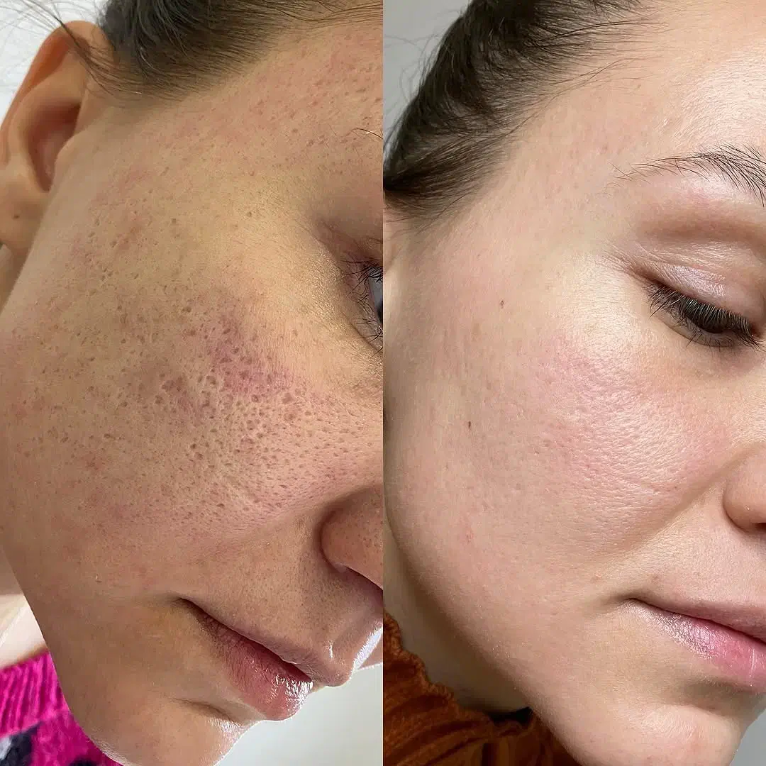 لیزرco2ترکیبی تک جلسه ای هموارساز اف ویژه|خدمات آرایشگری و زیبایی|دوگنبدان, |دیوار