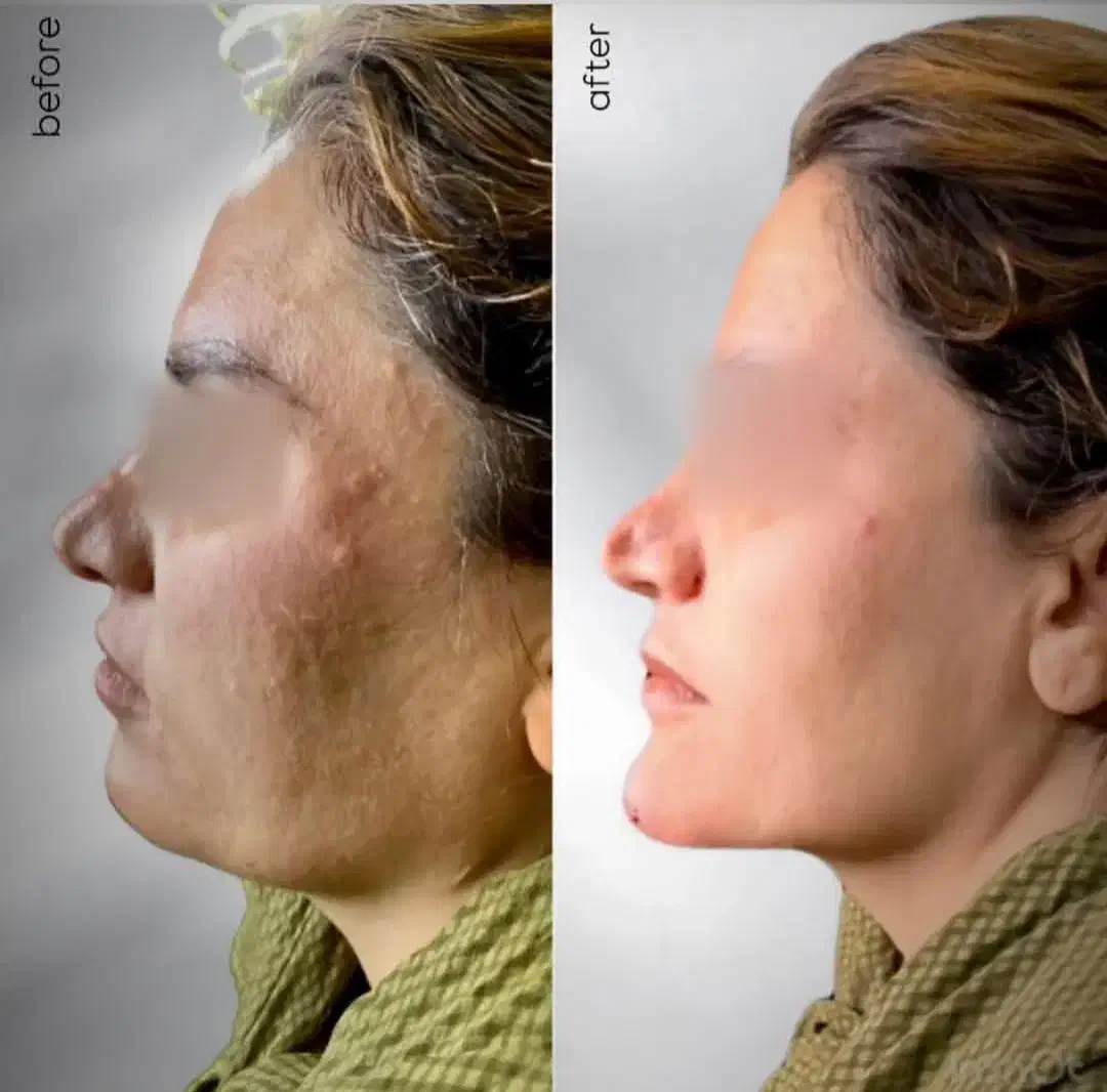 اف ویژه تمام خدمات زیبایی و جراحی در مطب|خدمات آرایشگری و زیبایی|یاسوج, |دیوار