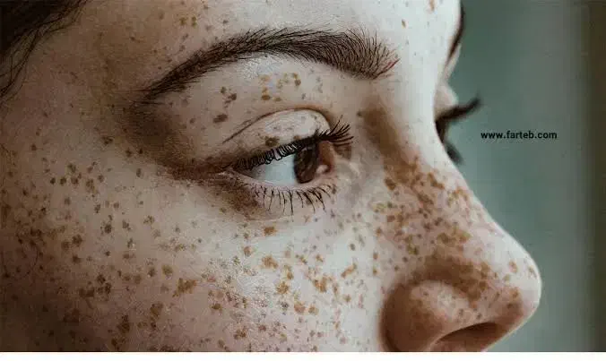 درمان و لیزر تضمینی کک و مک و لک فقط در 1 جلسه|خدمات آرایشگری و زیبایی|اصفهان, لاله|دیوار