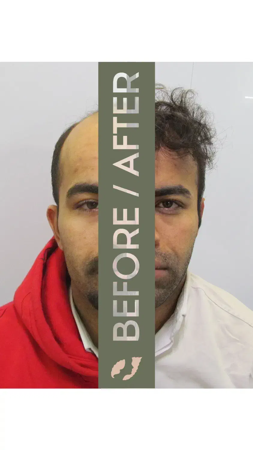 کاشت مو و ابرو|خدمات آرایشگری و زیبایی|تهران, جردن|دیوار