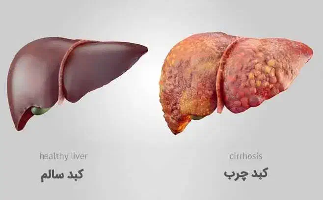 درمان قطعی کبد|آرایشی، بهداشتی، درمانی|کرمان, |دیوار