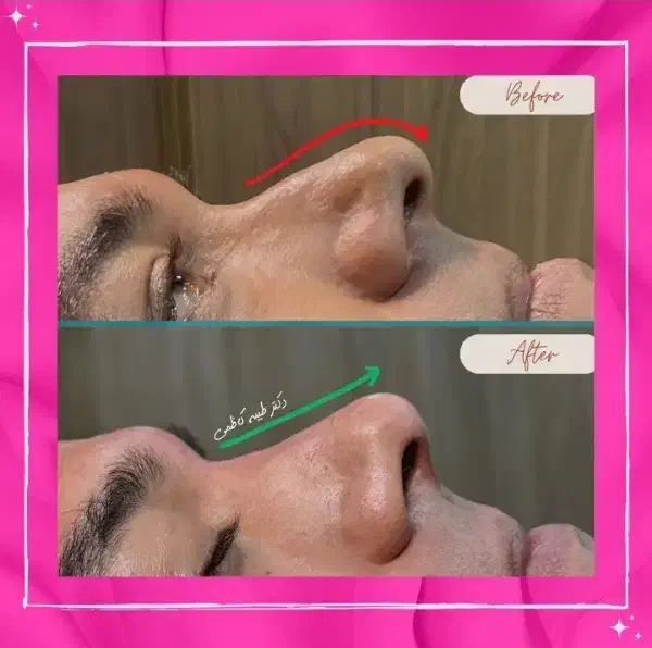 تخفیفات30درصدی ژل و بوتاکس وفیلر دکتر زیبایی|خدمات آرایشگری و زیبایی|مشهد, کوثر|دیوار