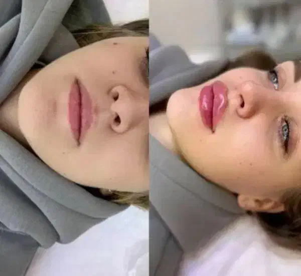 جشنواره ۵۰ درصدی ژل بوتاکس فقط تا سه روز|خدمات آرایشگری و زیبایی|اصفهان, برازنده|دیوار