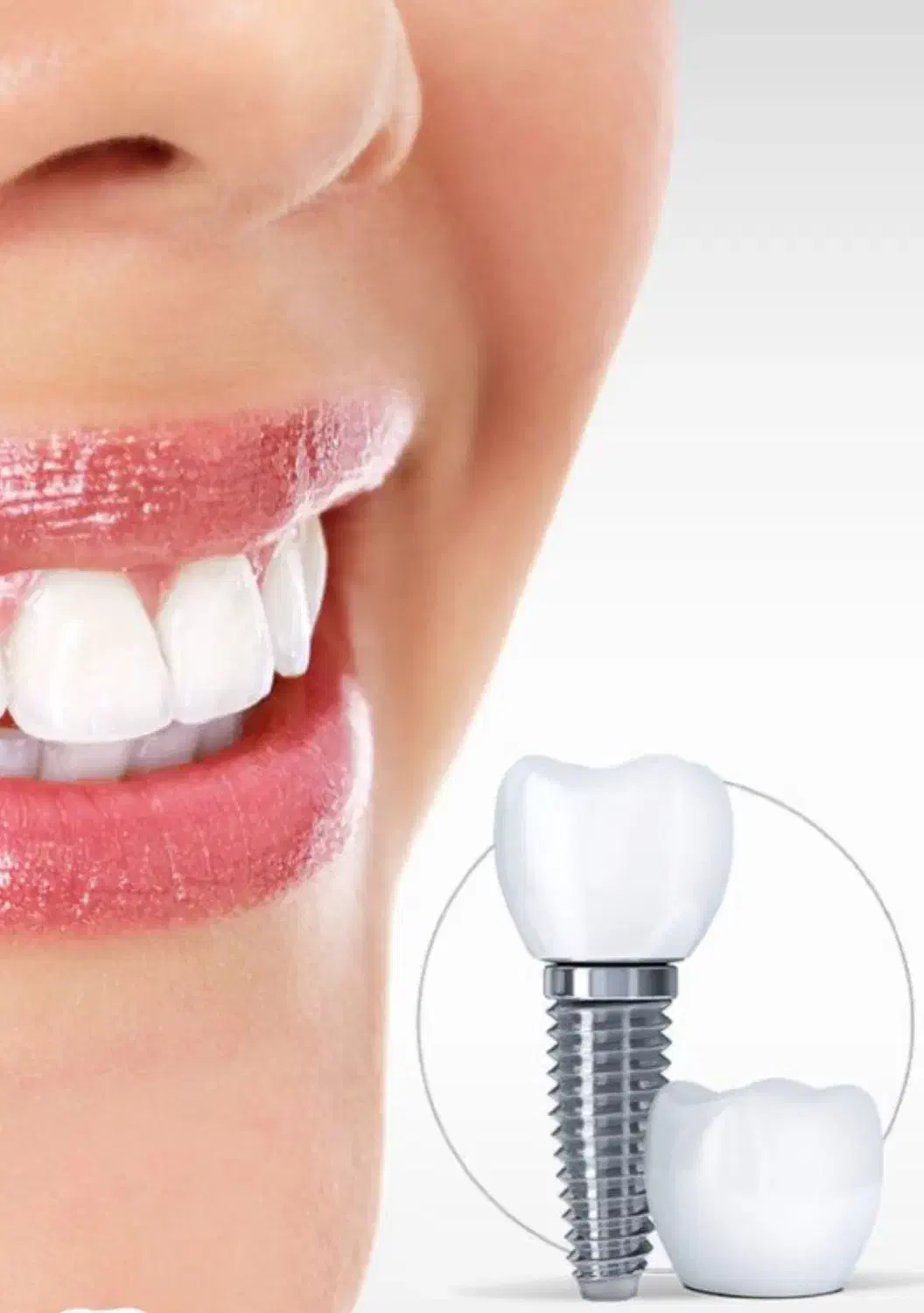 ایمپلنت دندان کره ای و سوئیسی با تخفیف پاییزه|خدمات آرایشگری و زیبایی|قرچک, پارس سرام|دیوار