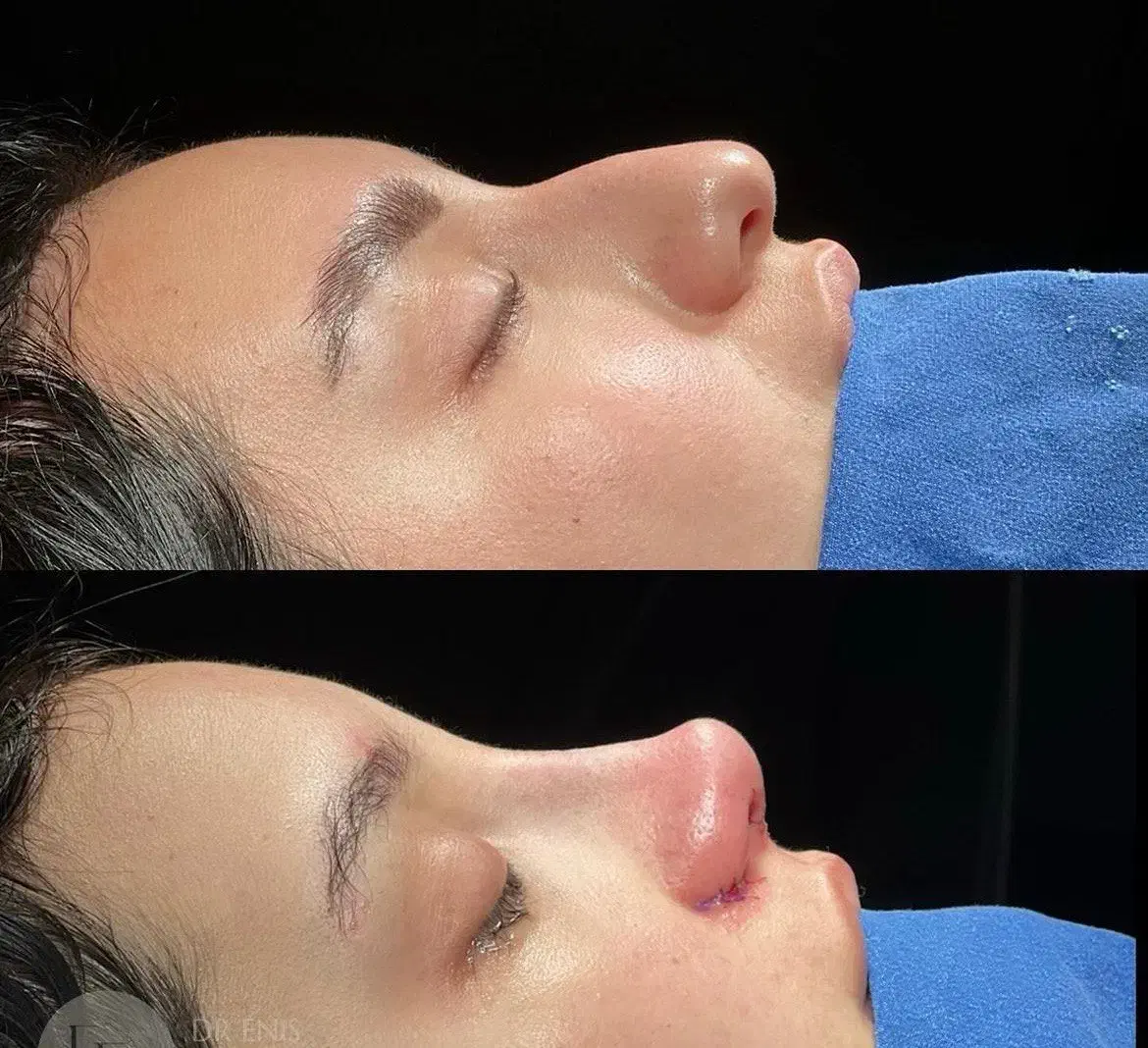 جراحی بینی|خدمات آرایشگری و زیبایی|ساری, |دیوار