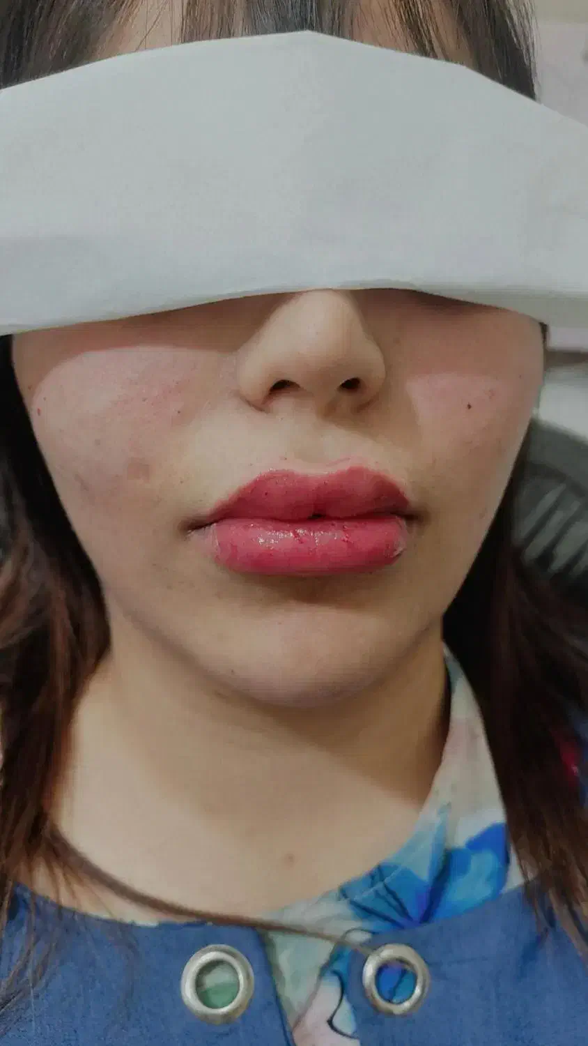 ژل و بوتاکس|خدمات آرایشگری و زیبایی|مسجد سلیمان, |دیوار