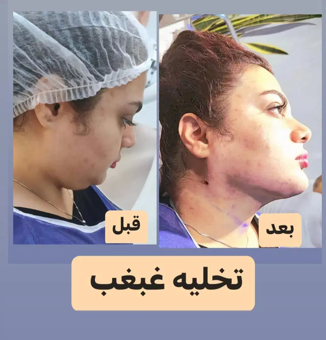 جشنواره ساکشن  غبغب،تزریق چربی ،بوتاکس ، هایفو ونخ|خدمات آرایشگری و زیبایی|تهران, شهر زیبا|دیوار