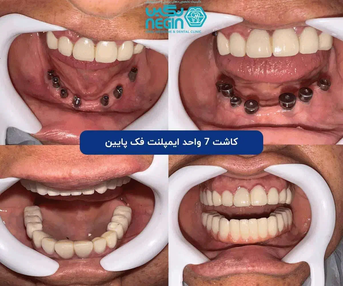 ایمپلنت دیجیتال اقساطی بدون سود در انواع برندها|خدمات آرایشگری و زیبایی|شیراز, زرگری|دیوار