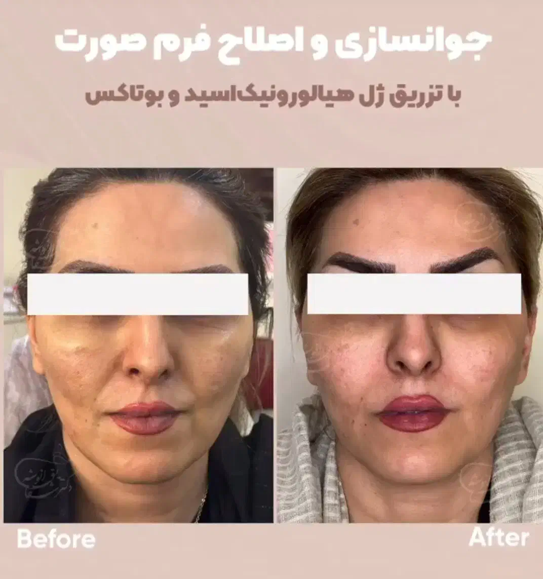 تزریقات. و جوانسازی پوست با فیلر و بوتاکس|آرایشی، بهداشتی، درمانی|اهواز, زیتون کارگری|دیوار