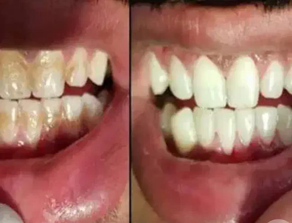 جرم گیری دندان تقریبا رایگان|خدمات آرایشگری و زیبایی|بیرجند, |دیوار