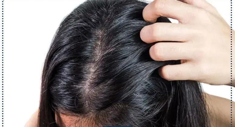 درمان بدون درد سر شوره مو|آرایشی، بهداشتی، درمانی|شادگان, |دیوار