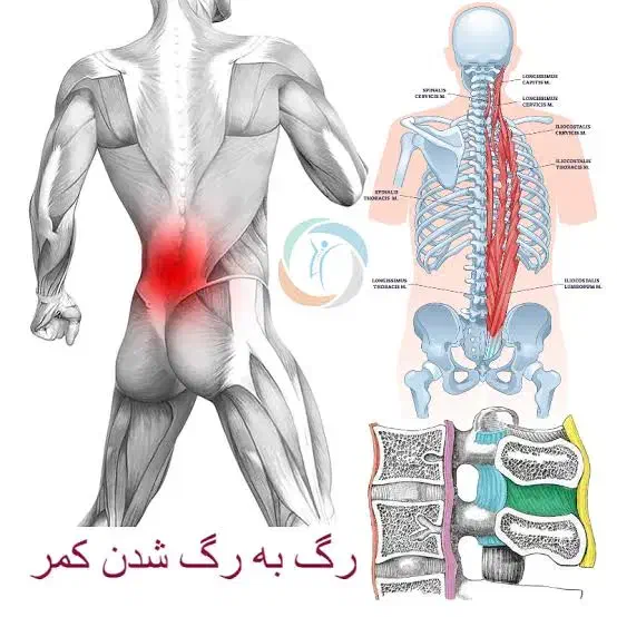 راهنمای واس دیسک کمر و رگ سیاتیک و گرفتگی غضلات|فعالیت داوطلبانه|الوند, |دیوار