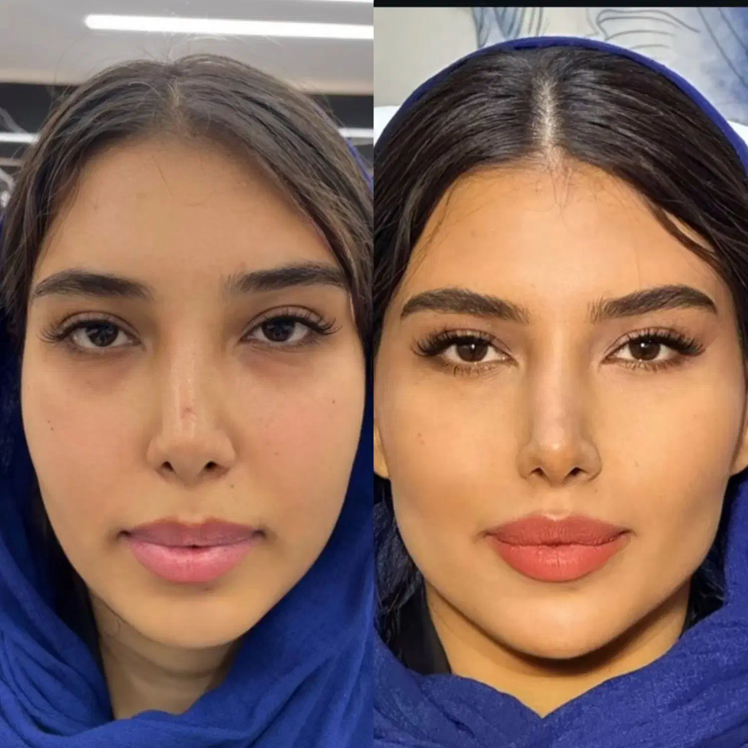 تزریق فیلر، بوتاکس، مادلینگ زیر نظر متخصص|خدمات آرایشگری و زیبایی|کرمانشاه, |دیوار