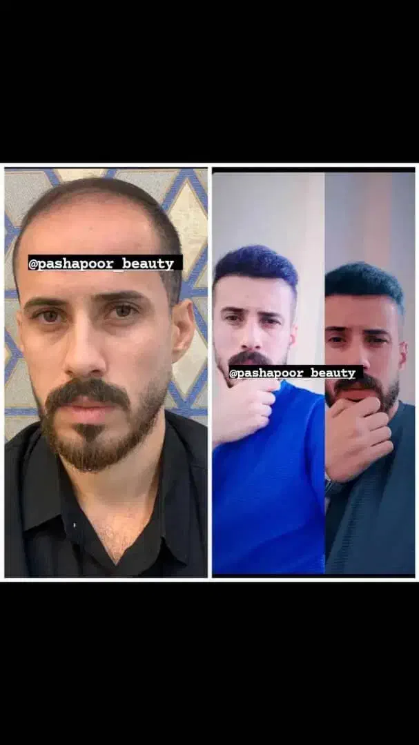 کاشت مو تخصصی|خدمات آرایشگری و زیبایی|پارس‌آباد, |دیوار