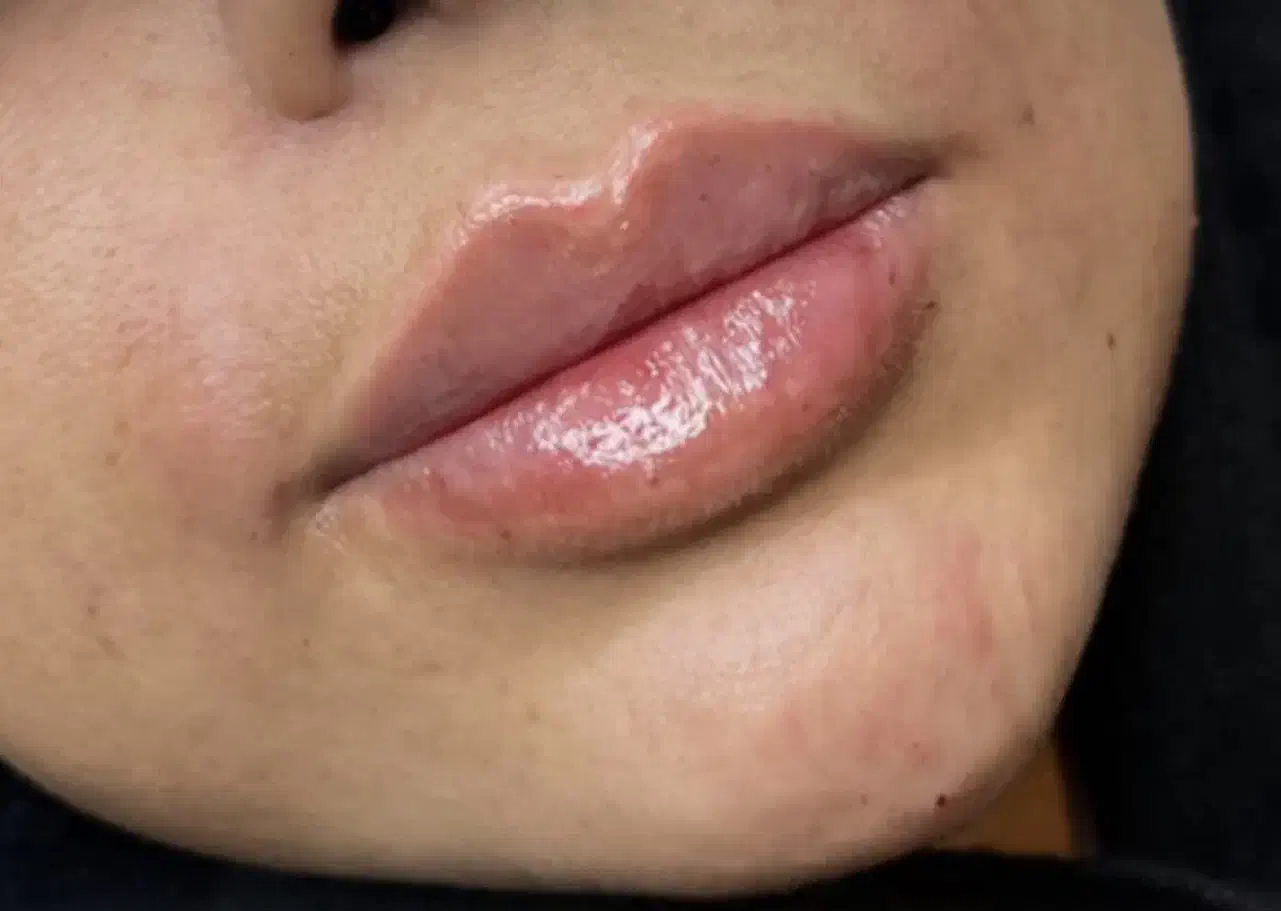 تزریق ژل|خدمات آرایشگری و زیبایی|یاسوج, |دیوار