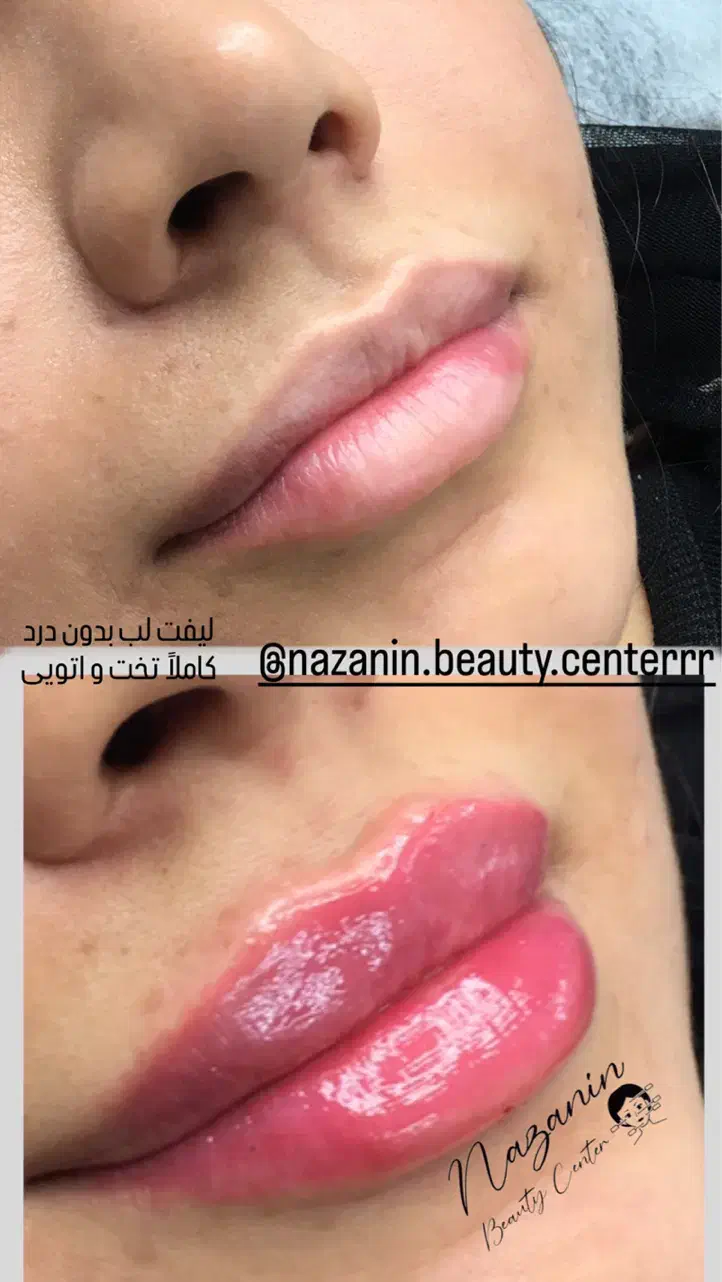 بوتاکس، فیلر و خدمات پیرسینگ|خدمات آرایشگری و زیبایی|رشت, خواهر امام|دیوار