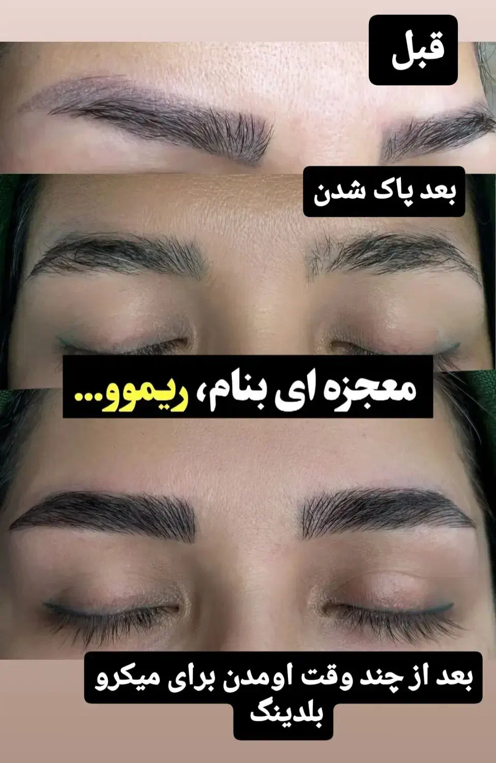 ریموو تک جلسه  با تخفیف ویژه|خدمات آرایشگری و زیبایی|تربت جام, پاسداران|دیوار