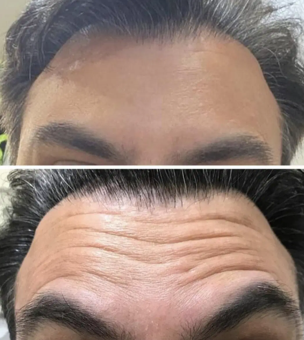 تخفیفات تزریق ژل و بوتاکس تخصصی درکلینیک توسط پزشک|خدمات زیبایی و سلامت|کرج, گوهردشت|دیوار
