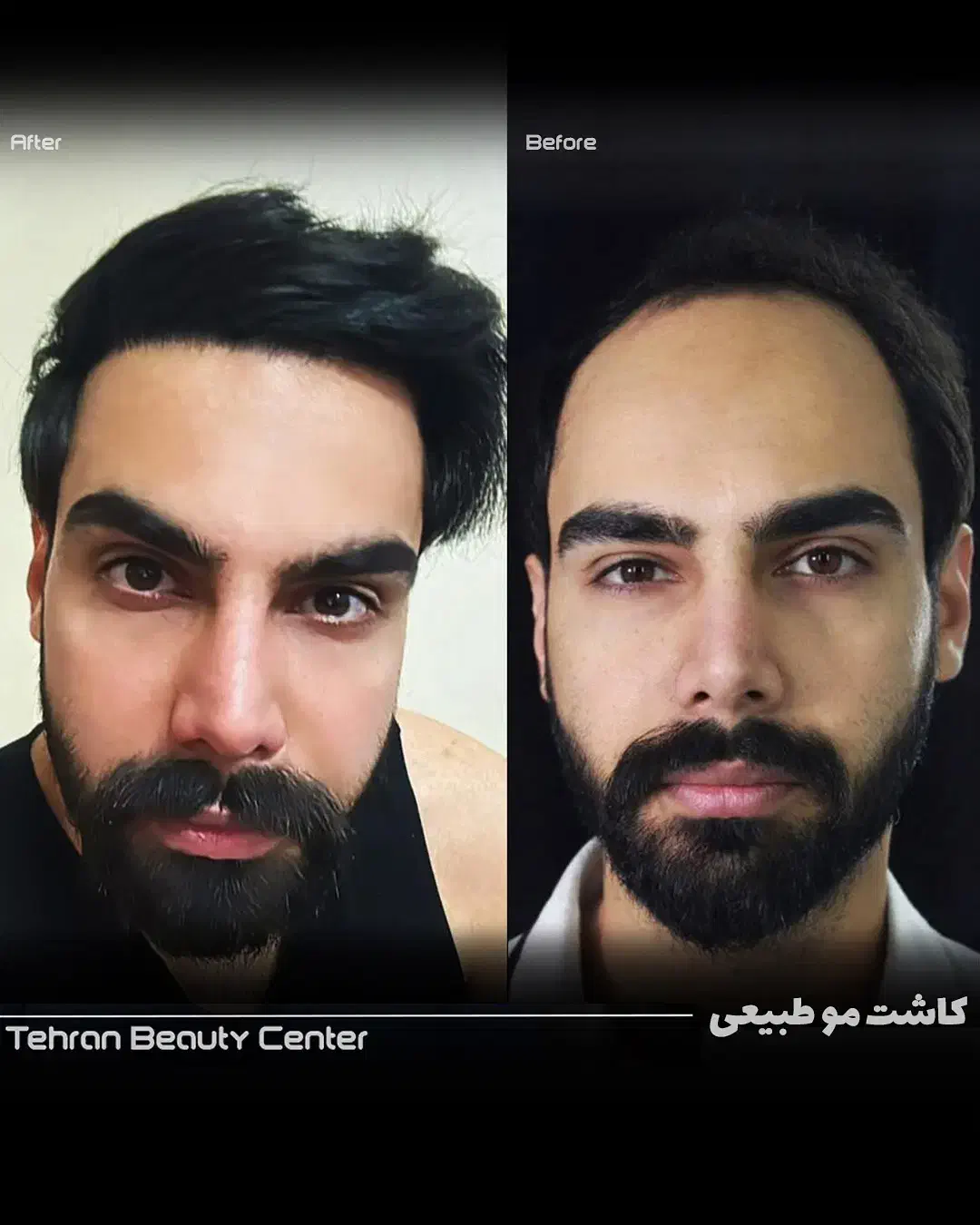 عمل بینی/ کاشت ابرو و مو / بلفارو /تزریق چربی|خدمات آرایشگری و زیبایی|قم, نوبهار|دیوار