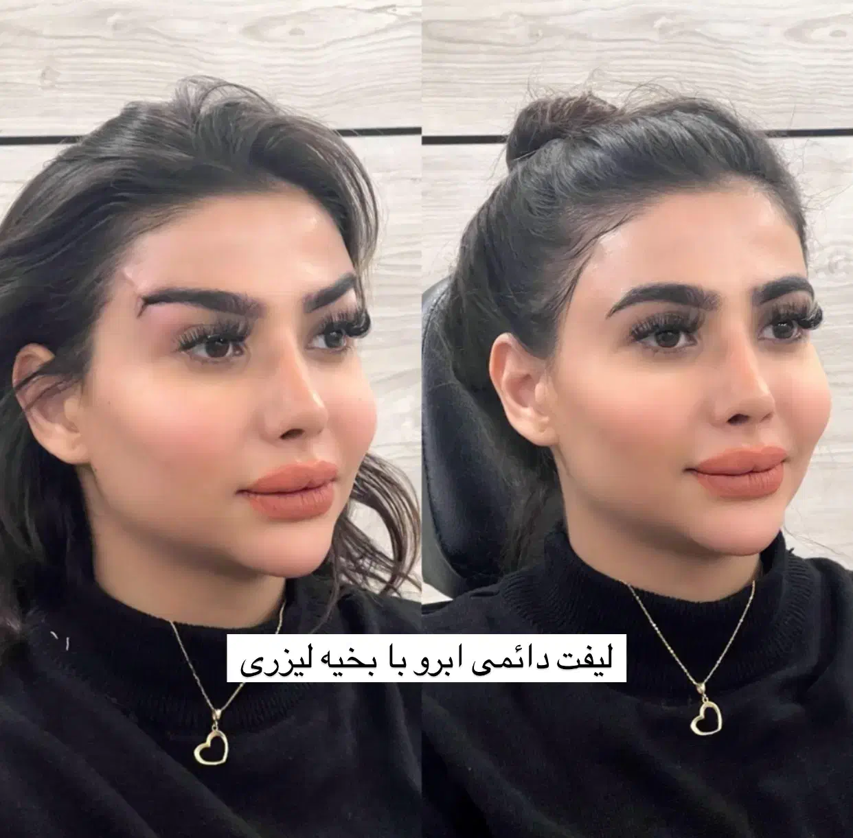 جراحی لیفت ابرو،دایرکت ابرو،لیفت شقیق ،پیشانی|خدمات آرایشگری و زیبایی|تهران, پاسداران|دیوار