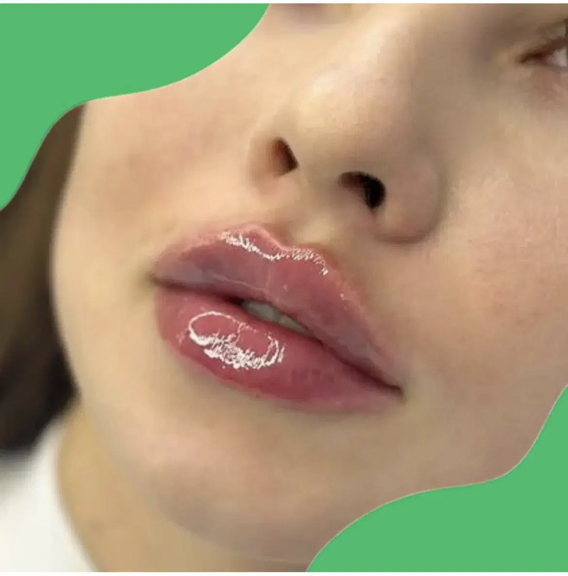 جشنواره یلدایی تخفیف ژل لب،بوتاکس توسط پزشک متخصص|خدمات آرایشگری و زیبایی|کرج, گلشهر|دیوار