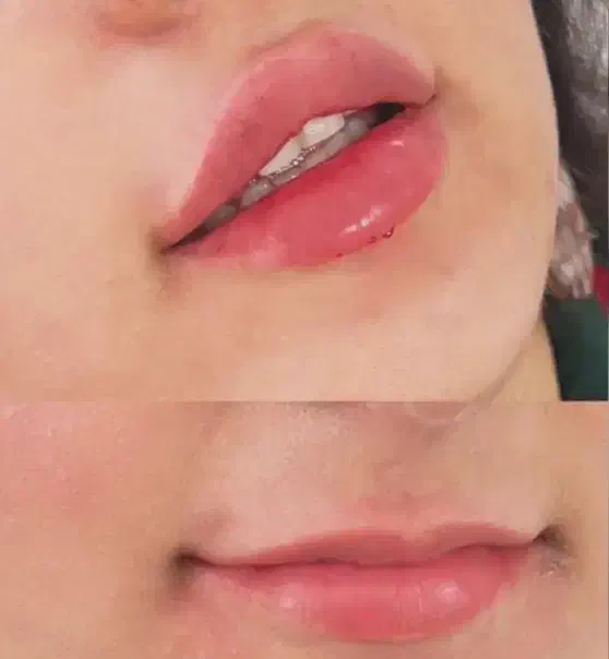 ژل و بوتاکس باقیمت استثنایی|خدمات آرایشگری و زیبایی|بروجرد, |دیوار