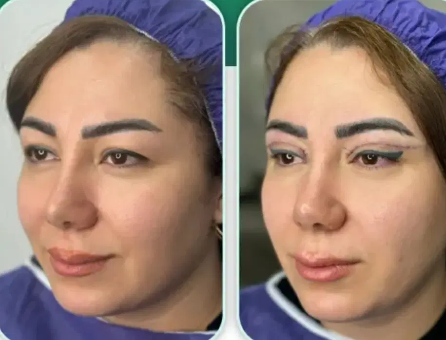 جراحی پلک 8 دایرکت ابرو 8 ساکشن غبغب 10 اتوپلاستی|خدمات زیبایی و سلامت|تهران, آسمان|دیوار