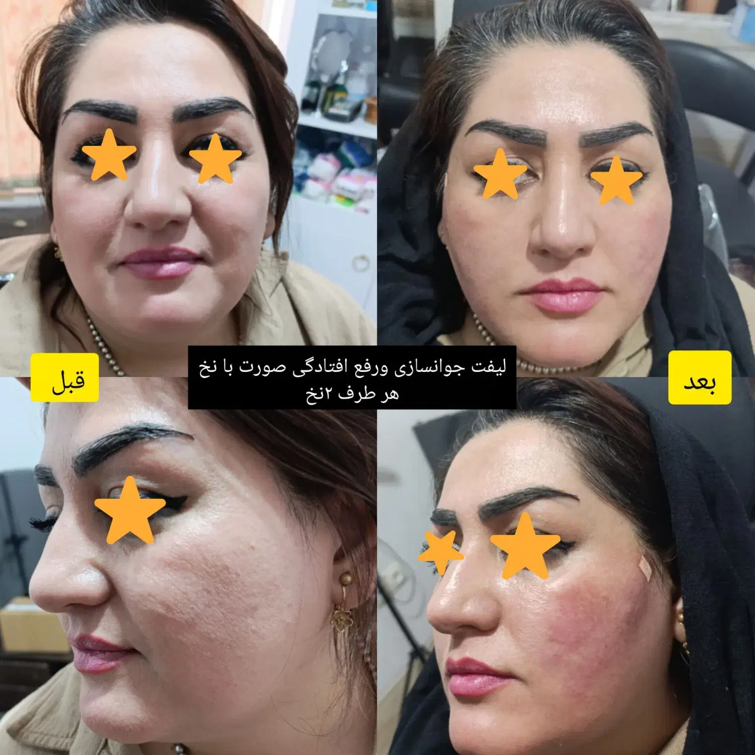 لیفت وجوانسازی با نخ های کاگ و تزریق فیلر ومزوها|خدمات آرایشگری و زیبایی|شیراز, میانرود|دیوار