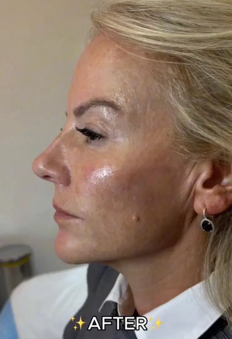 پاک کردن تتو با لیرز در مطب|خدمات آرایشگری و زیبایی|مشهد, احمدآباد|دیوار