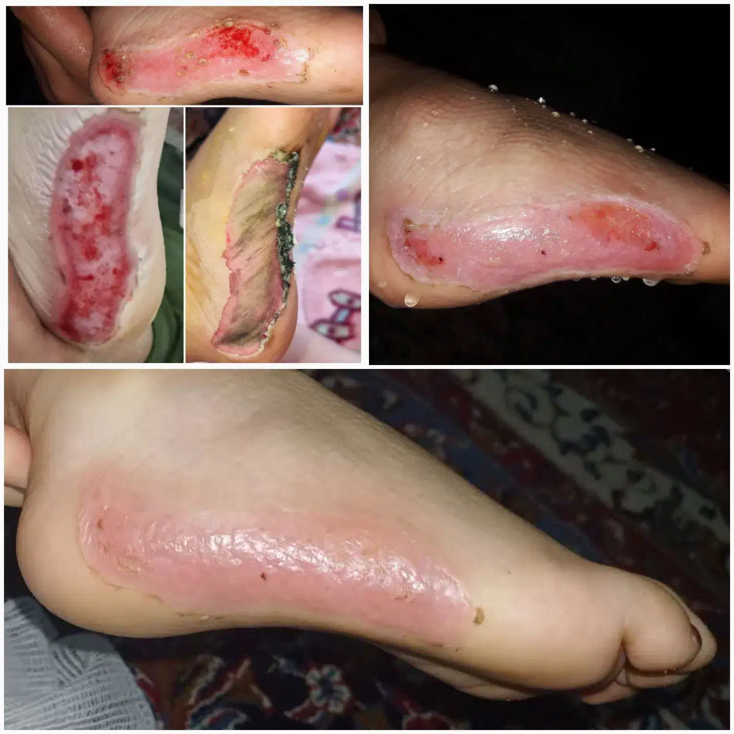 کارشناس تخصصی زخم و استوما|خدمات آرایشگری و زیبایی|قم, زنبیل آباد|دیوار