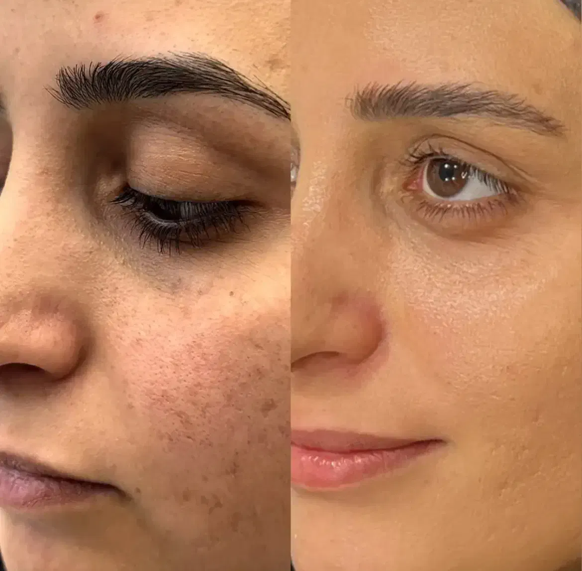 خروج لک و کک مک جای جوش با درمان تلفیقی|خدمات آرایشگری و زیبایی|سبزوار, کاشفی شمالی (دادگستری)|دیوار