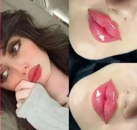 (جشنواره) تزریق ژل و بوتاکس توسط پزشک در مطب|خدمات آرایشگری و زیبایی|اصفهان, لاله|دیوار