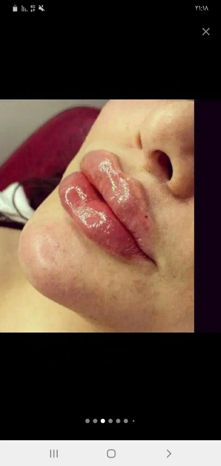 ژل .بوتاکس .هایفو.ساکشن غبغب وساکشن شکم وپهلو|خدمات آرایشگری و زیبایی|اصفهان, رکن الدوله غربی|دیوار