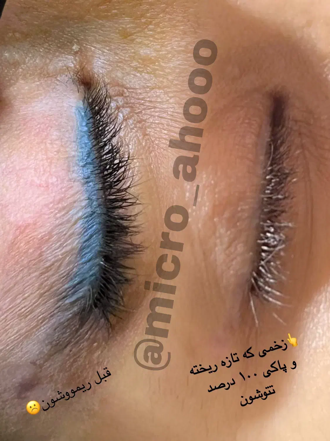 دیگه نگران تکرار زیاد جلسات پاک شدن تتوت نباش|خدمات آرایشگری و زیبایی|بندر گناوه, |دیوار