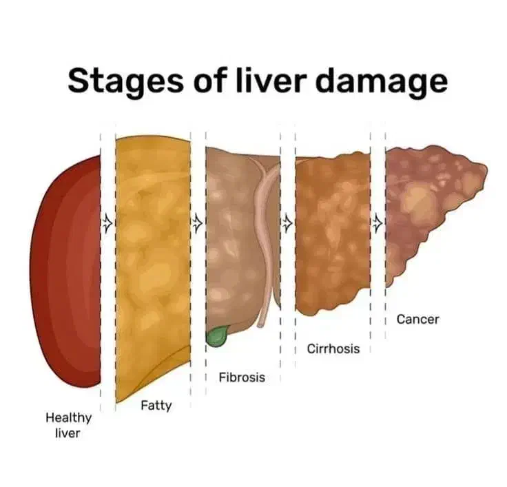 پاکسازی کبد|آرایشی، بهداشتی، درمانی|رشت, بازار|دیوار