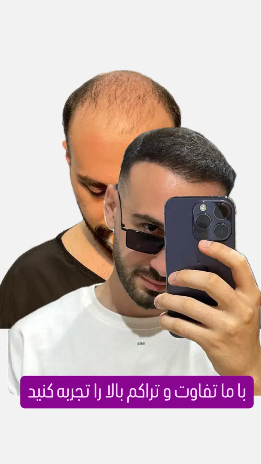 کاشت مو تبریزقیمت مناسب اقساطی فول تراکم|خدمات آرایشگری و زیبایی|صوفیان, |دیوار