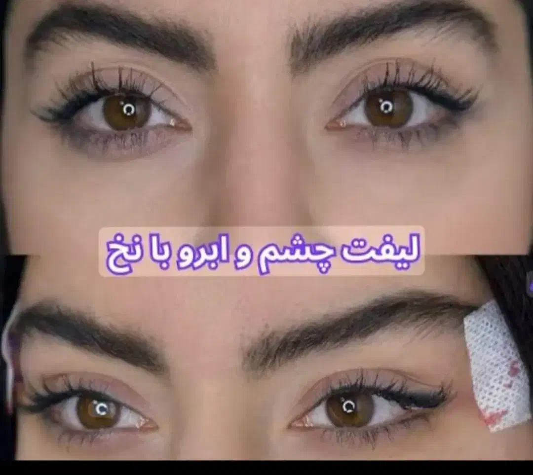 تزریق ژل و بوتاکس چربی فیلر|خدمات آرایشگری و زیبایی|بومهن, |دیوار