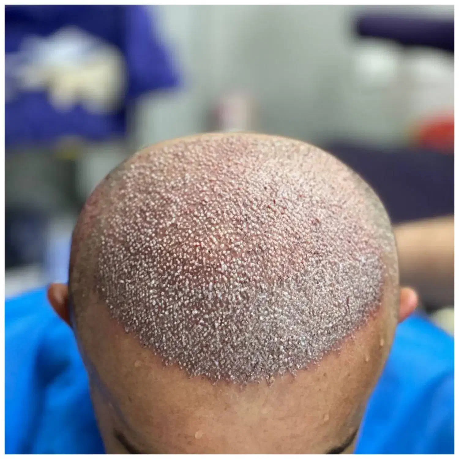 کاشت مو /کاشتمو/کاشتمو شیراز|خدمات آرایشگری و زیبایی|شیراز, قصرالدشت|دیوار