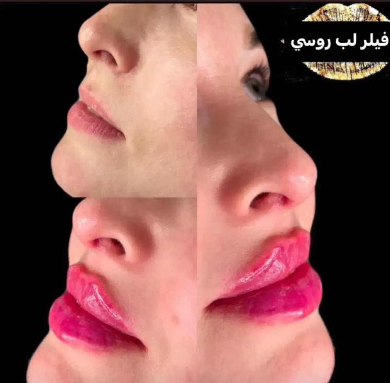 جشنواره ژل و بوتاکس و مزوژل|خدمات آرایشگری و زیبایی|تهران, ظفر|دیوار