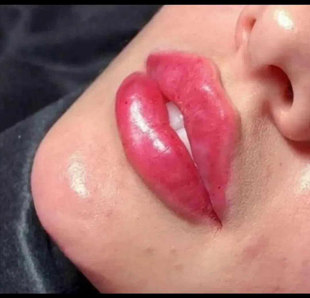 (کلینیک زیبایی) فیلر،بوتاکس مزوژل جوانساز، ضدلک|خدمات آرایشگری و زیبایی|قشم, |دیوار