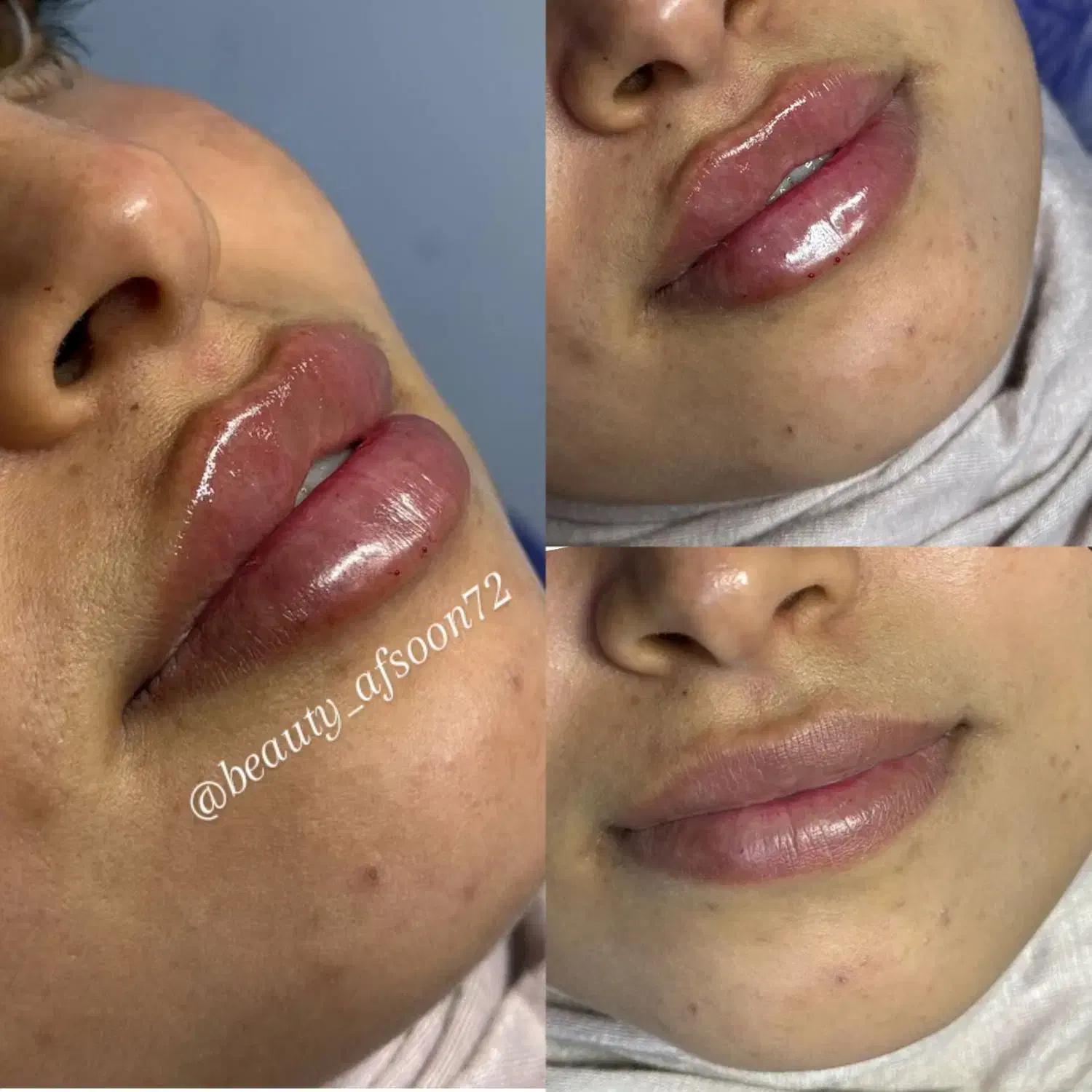 تخفیف استثنایی خدمات ژل فیلر بوتاکس|خدمات آرایشگری و زیبایی|کرج, گلشهر|دیوار