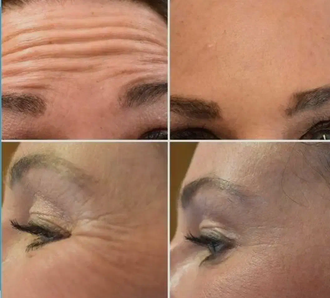 خدمات جوانسازی با بوتاکس|خدمات آرایشگری و زیبایی|چمستان, |دیوار