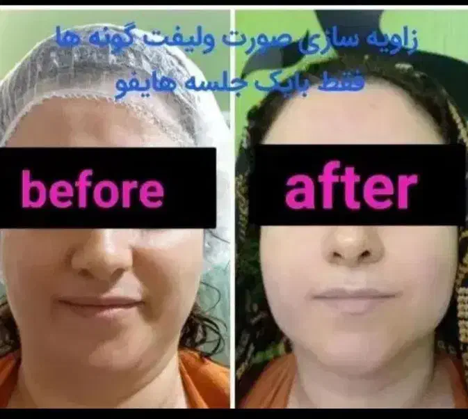 هایفوتراپی،رفع غبغب،لیزر،امبدینگ لاغری،prp|خدمات آرایشگری و زیبایی|سیرجان, |دیوار