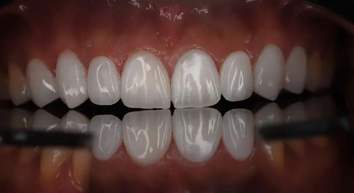 دندانسازی دندانپزشکی کامپوزیت فکی 10درمطب ارتودنسی|خدمات آرایشگری و زیبایی|رشت, استقامت ۱|دیوار