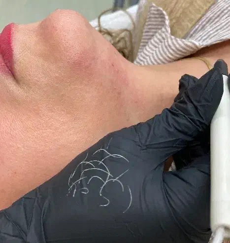 لیزر موهای سفید و سیاه با جدیدترین دستگاه‌ها|خدمات آرایشگری و زیبایی|رشت, گلسار|دیوار