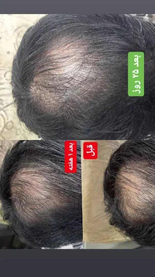 درمان انواع مشکلات پوست و مو|آرایشی، بهداشتی، درمانی|بروجرد, |دیوار